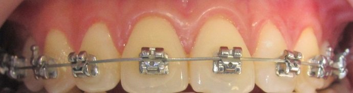 L'essor de l'Orthodontie avec les Mini-Vis d'Ancrage - CISCO - Formation en  orthodontie en France, formation orthodontie à Paris, formation  d'orthodontiste