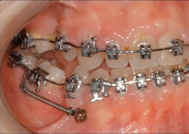 orthodontiste_marseille - Pose de mini vis d'ancrage lorsqu'il n'est pas  possible de s'appuyer sur les dents trop fragiles chez l'adulte . Ce  patient est en cours de préparation orthodontique en vue d'une
